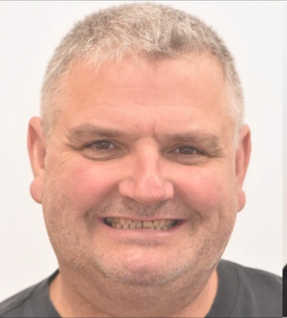 Before: worn and discoloured teeth