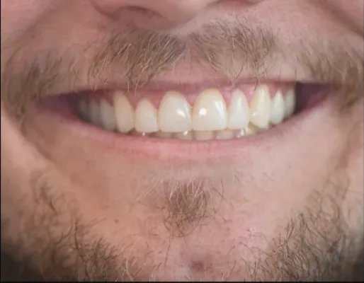 After: straightened, brighter smile after treatment at Redwater Dental Clinic