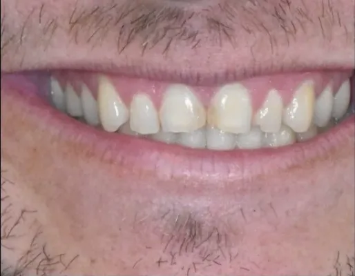 Before: crowded, uneven front teeth