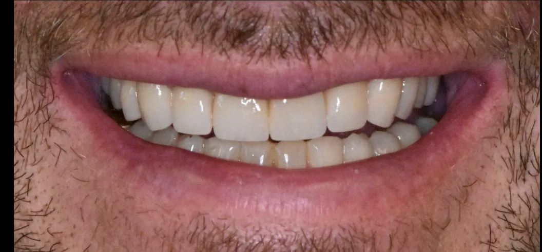 After: even, restored smile after treatment at Redwater Dental Clinic