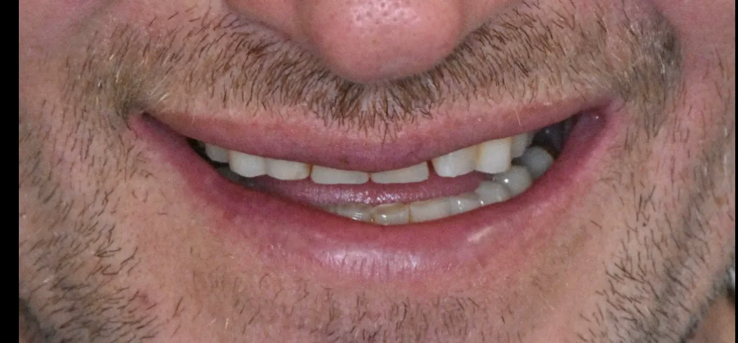 Before: worn and uneven front teeth